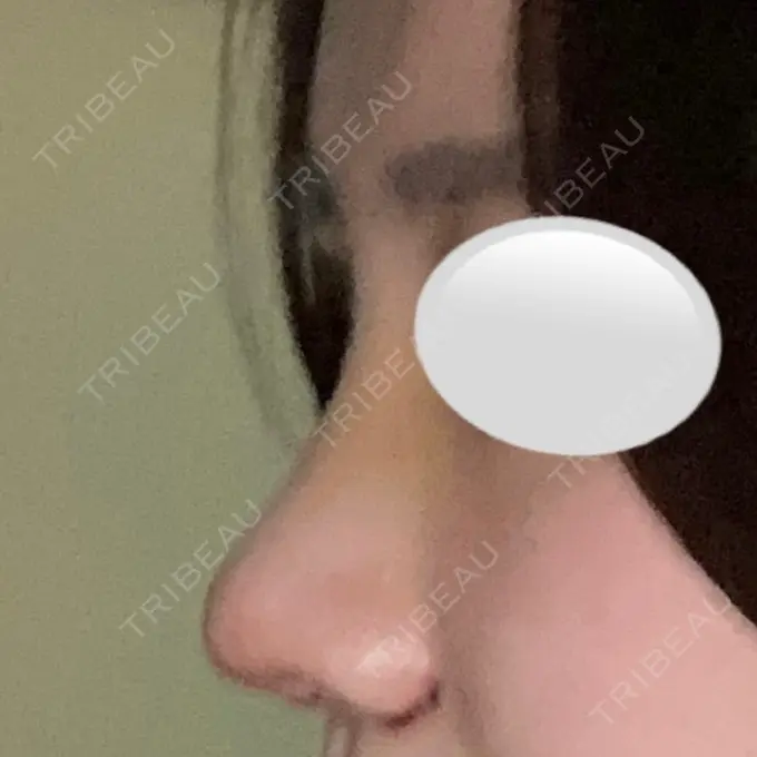 鼻中隔延長（切開） / 小鼻縮小（切開） / 鼻尖縮小 みずほクリニック DAY 5 メイン用