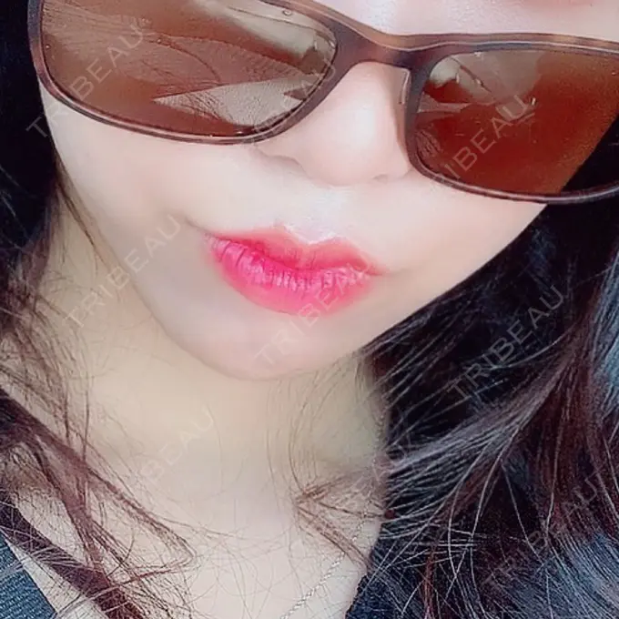 肌ヒアルロン酸注入（たるみ・シワ改善） / ボトックス（エラ・小顔） / その他（鼻） YBC横浜美容外科 大宮院 DAY 15 メイン用