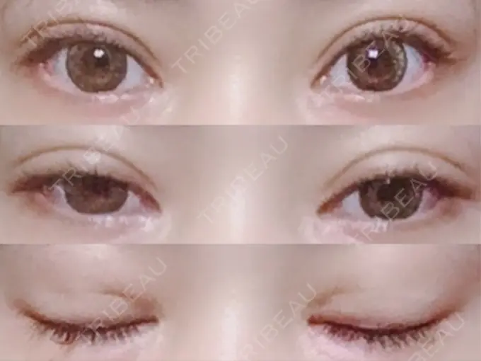 二重切開 / 目頭切開 湘南美容クリニック 池袋西口院 DAY 148 メイン用