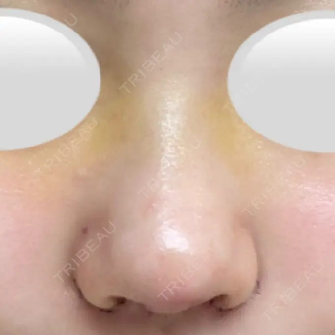 鼻中隔延長（切開） / 小鼻縮小（切開） / 鼻尖縮小 みずほクリニック DAY 5 メイン用