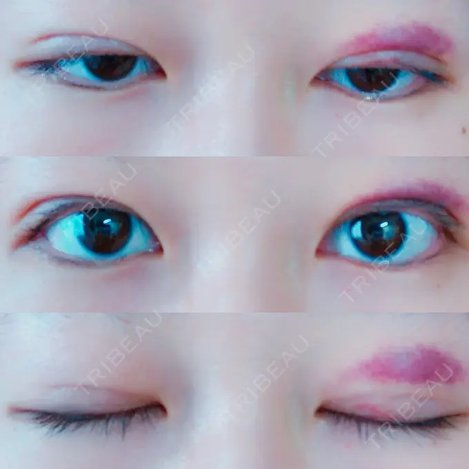 二重埋没 湘南美容クリニック 東京蒲田院 DAY 9 メイン用