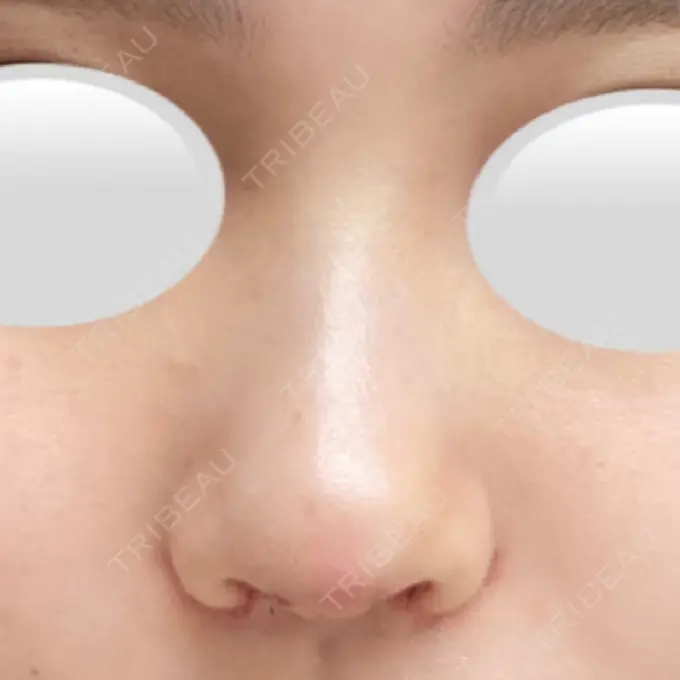 鼻中隔延長（切開） / 小鼻縮小（切開） / 鼻尖縮小 みずほクリニック DAY 7 メイン用