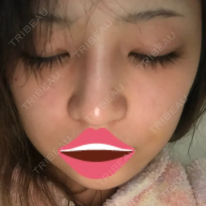 ヒアルロン酸注入（鼻） プライベートスキンクリニック 梅田本院 DAY 2 メイン用