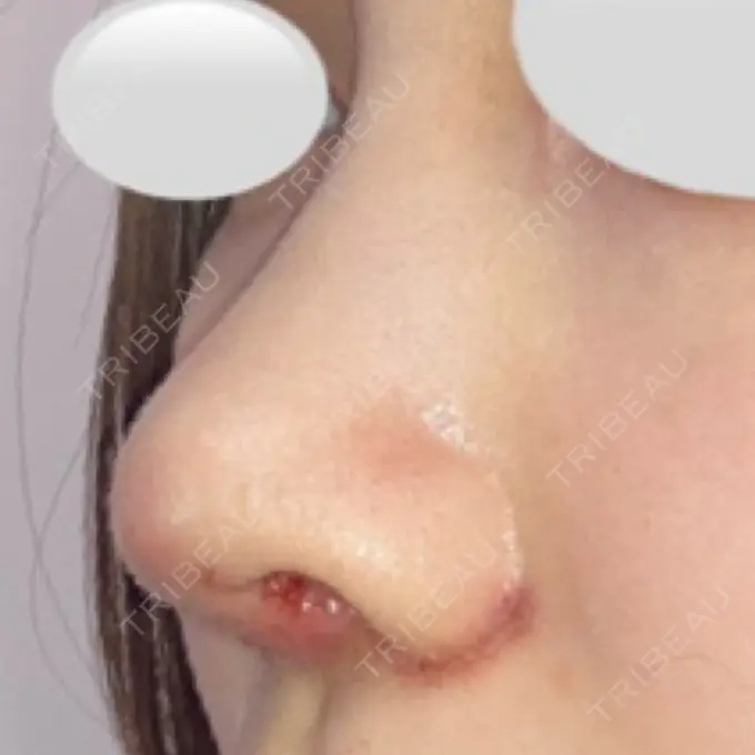 鼻中隔延長（切開） / 小鼻縮小（切開） / 鼻尖縮小 みずほクリニック DAY 7 メイン用