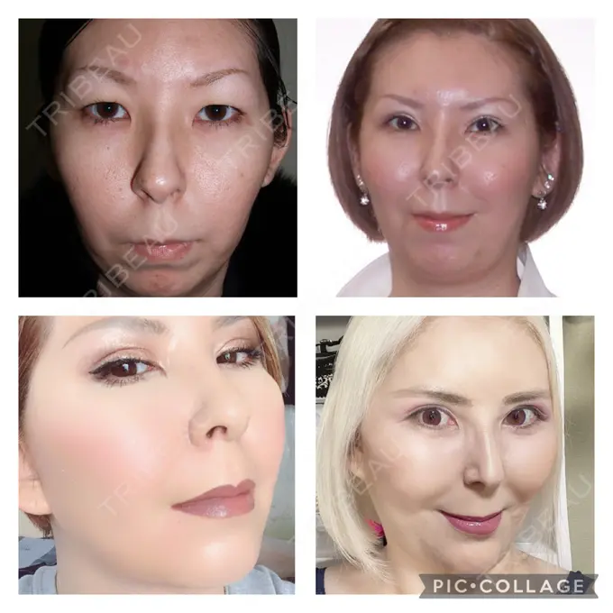 あごプロテーゼ / 輪郭修正 / ボトックス（あご） / ヒアルロン酸注入（頬） CLASSY 仙台美容外科・美容皮膚科 AFTER メイン用