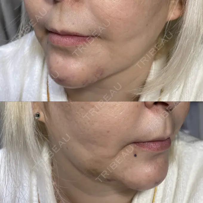 あごプロテーゼ / 輪郭修正 / ボトックス（あご） / ヒアルロン酸注入（頬） CLASSY 仙台美容外科・美容皮膚科 DAY 9 メイン用