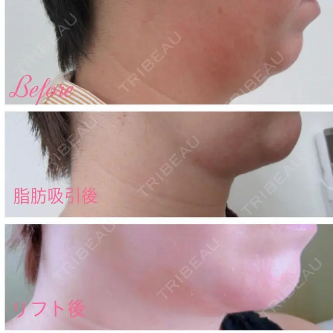 あごプロテーゼ / 輪郭修正 / ボトックス（あご） / ヒアルロン酸注入（頬） CLASSY 仙台美容外科・美容皮膚科 DAY 9 メイン用