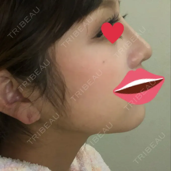 ヒアルロン酸注入（鼻） プライベートスキンクリニック 梅田本院 DAY 3 メイン用