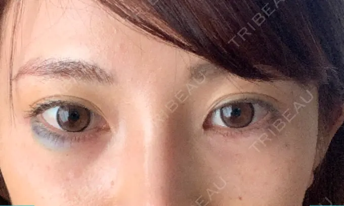 ヒアルロン酸注入（涙袋） / ボトックス（目尻） フィラークリニック 町田院 DAY 0 メイン用