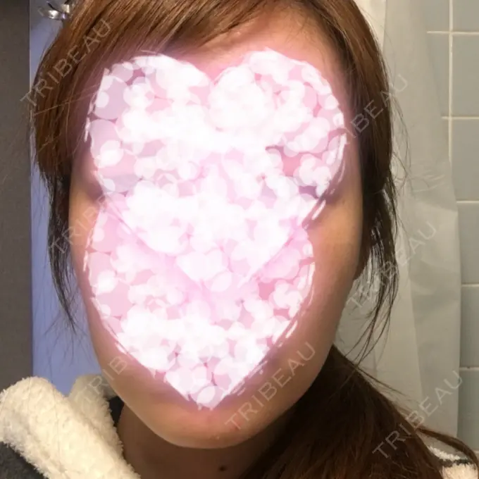 バッカルファット除去 / ボトックス（エラ・小顔） 湘南美容クリニック 秋葉原院 DAY 25 メイン用