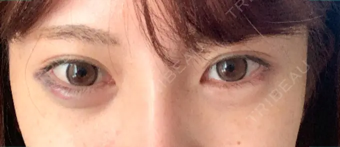 ヒアルロン酸注入（涙袋） / ボトックス（目尻） フィラークリニック 町田院 DAY 1 メイン用