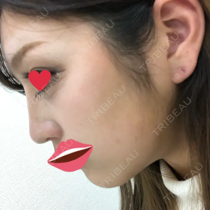 ヒアルロン酸注入（鼻） プライベートスキンクリニック 梅田本院 DAY 4 メイン用