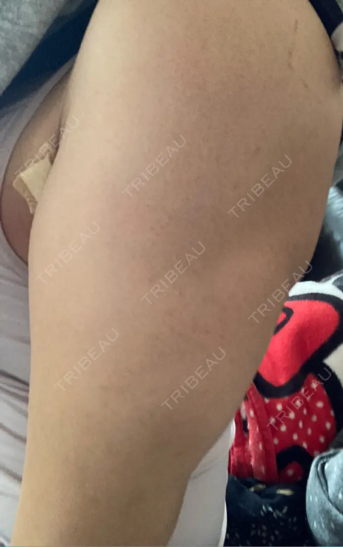 脂肪吸引（二の腕） 湘南美容クリニック 新潟院 DAY 212 メイン用