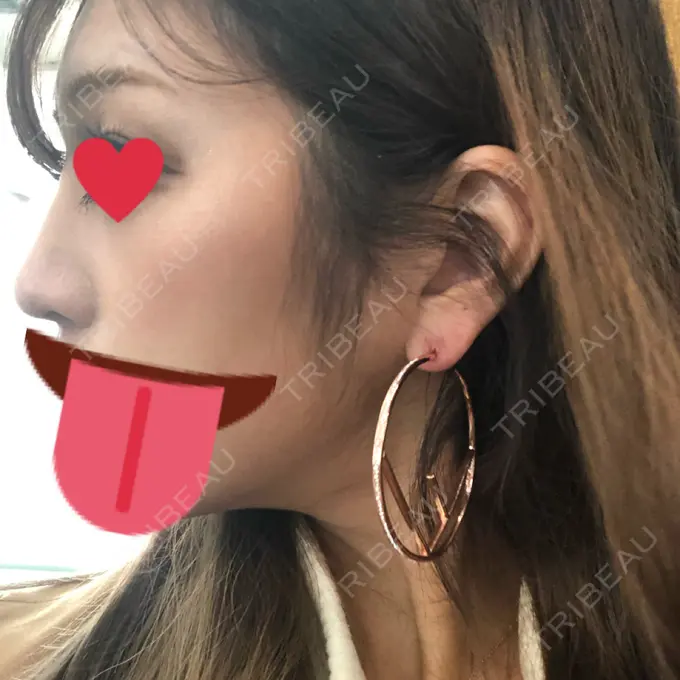 ヒアルロン酸注入（鼻） プライベートスキンクリニック 梅田本院 DAY 5 メイン用