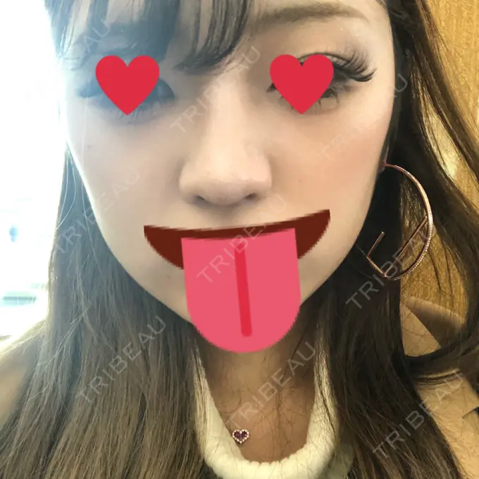 ヒアルロン酸注入（鼻） プライベートスキンクリニック 梅田本院 DAY 5 メイン用