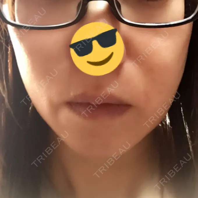 脂肪溶解注射（顔） 湘南美容クリニック 東京蒲田院 DAY 1 メイン用