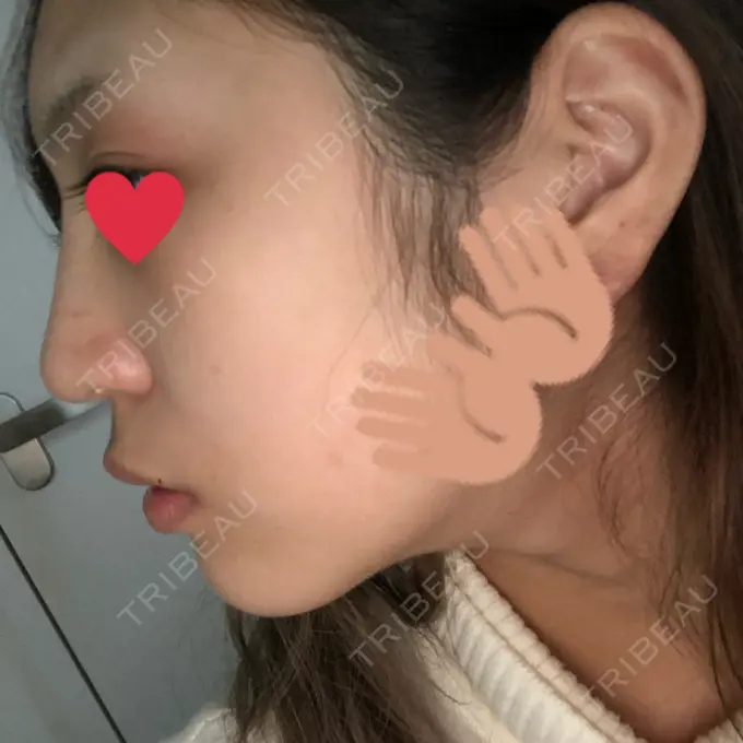 ヒアルロン酸注入（鼻） プライベートスキンクリニック 梅田本院 DAY 6 メイン用