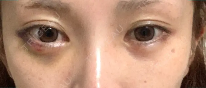 ヒアルロン酸注入（涙袋） / ボトックス（目尻） フィラークリニック 町田院 DAY 3 メイン用