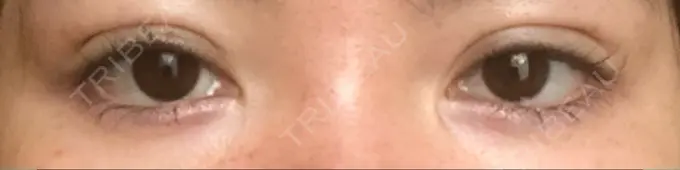 二重埋没 くさのたろうクリニック DAY 0 メイン用