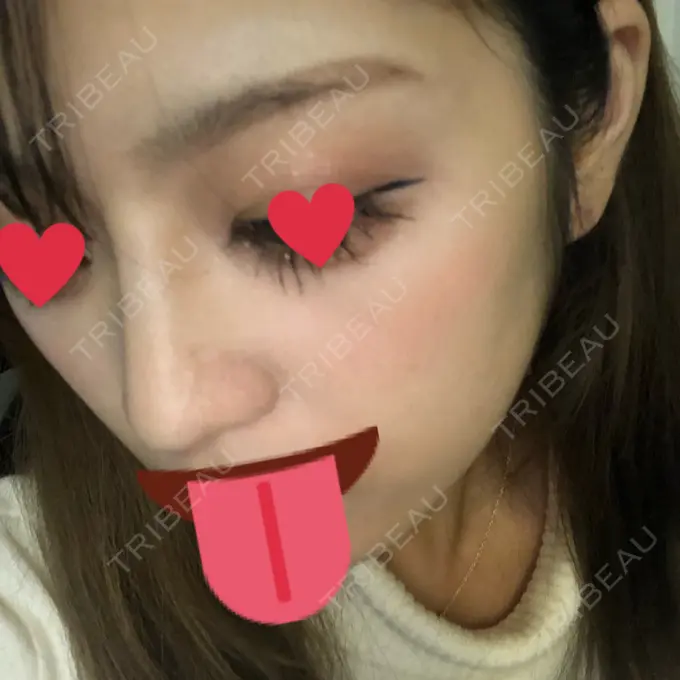 ヒアルロン酸注入（鼻） プライベートスキンクリニック 梅田本院 DAY 7 メイン用