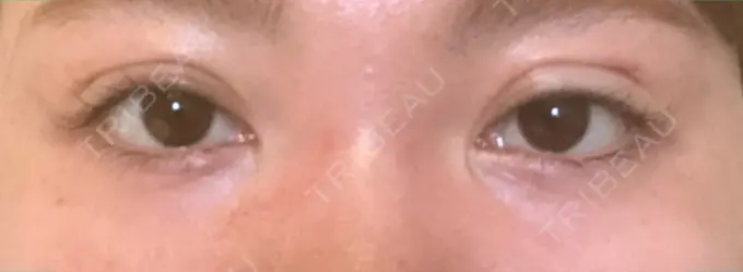 二重埋没 くさのたろうクリニック DAY 1 メイン用