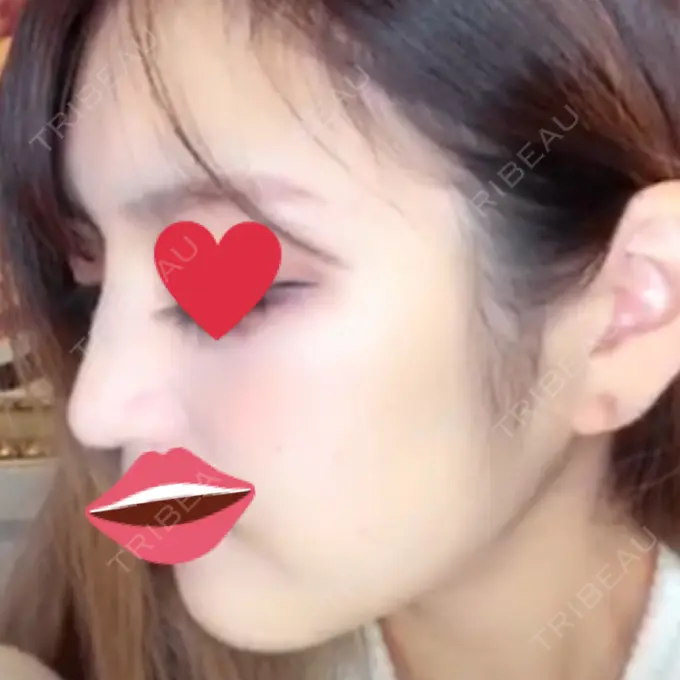 ヒアルロン酸注入（鼻） プライベートスキンクリニック 梅田本院 AFTER メイン用