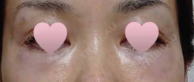 その他（目元） 赤坂プレミアクリニック AFTER メイン用