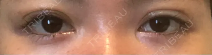 二重埋没 くさのたろうクリニック DAY 2 メイン用