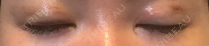 二重埋没 くさのたろうクリニック DAY 2 メイン用