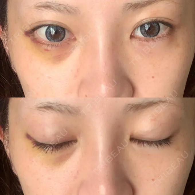 ヒアルロン酸注入（涙袋） / ボトックス（目尻） フィラークリニック 町田院 DAY 6 メイン用