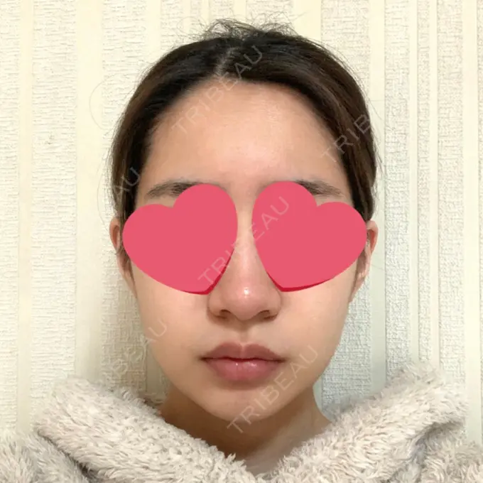 糸リフト / 脂肪吸引（顔） / メーラーファット除去 / ジョールファット除去 / ヒアルロン酸注入（頬） SEA CLINIC（シークリニック） DAY 22 メイン用