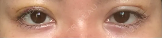 二重埋没 くさのたろうクリニック DAY 3 メイン用