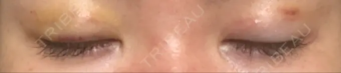 二重埋没 くさのたろうクリニック DAY 3 メイン用