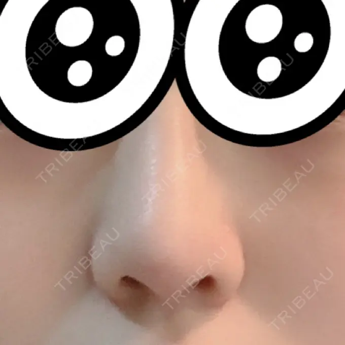 軟骨移植 GLANZ CLINIC DAY 13 メイン用