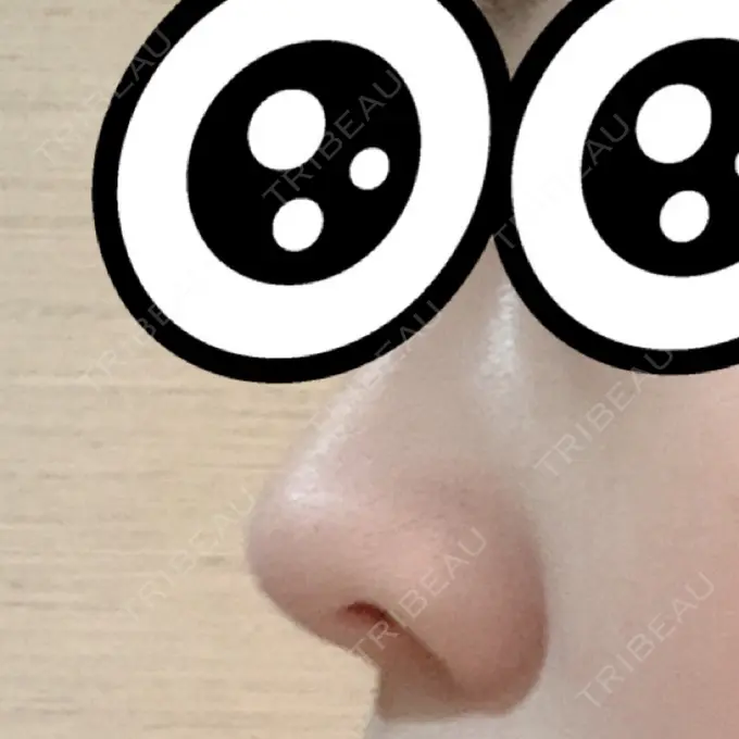 軟骨移植 GLANZ CLINIC DAY 13 メイン用