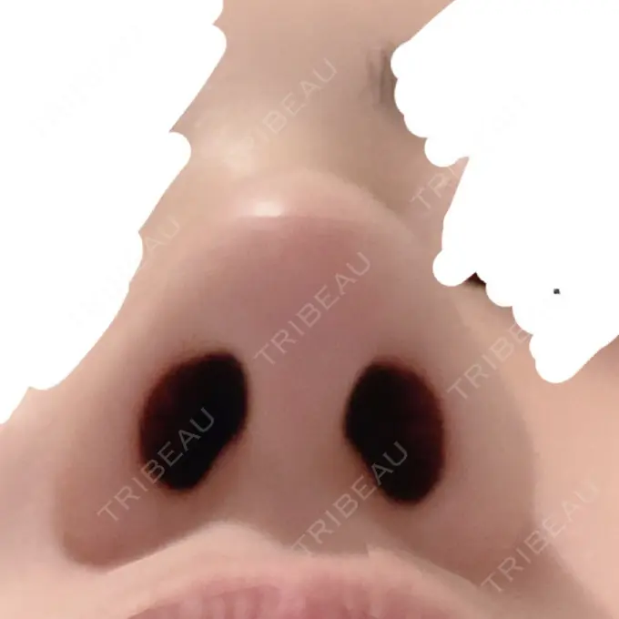 軟骨移植 GLANZ CLINIC DAY 14 メイン用