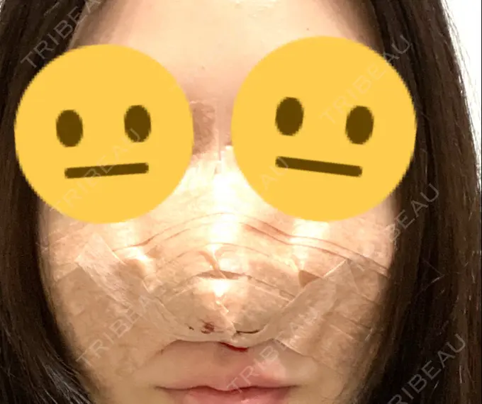 鼻尖形成（切開） / 鼻中隔延長（切開） みずほクリニック AFTER メイン用