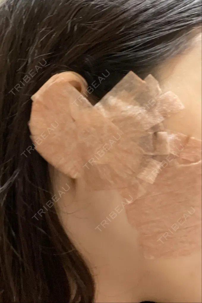 鼻尖形成（切開） / 鼻中隔延長（切開） みずほクリニック DAY 0 メイン用