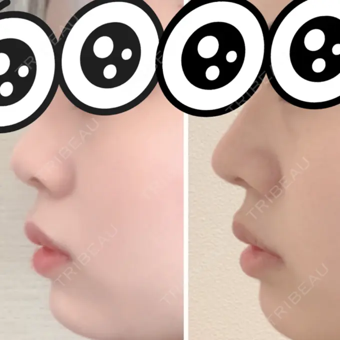 軟骨移植 GLANZ CLINIC DAY 16 メイン用