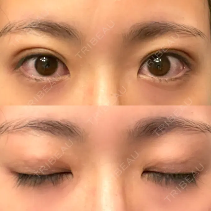 二重埋没 湘南メディカル記念病院（両国） DAY 18 メイン用