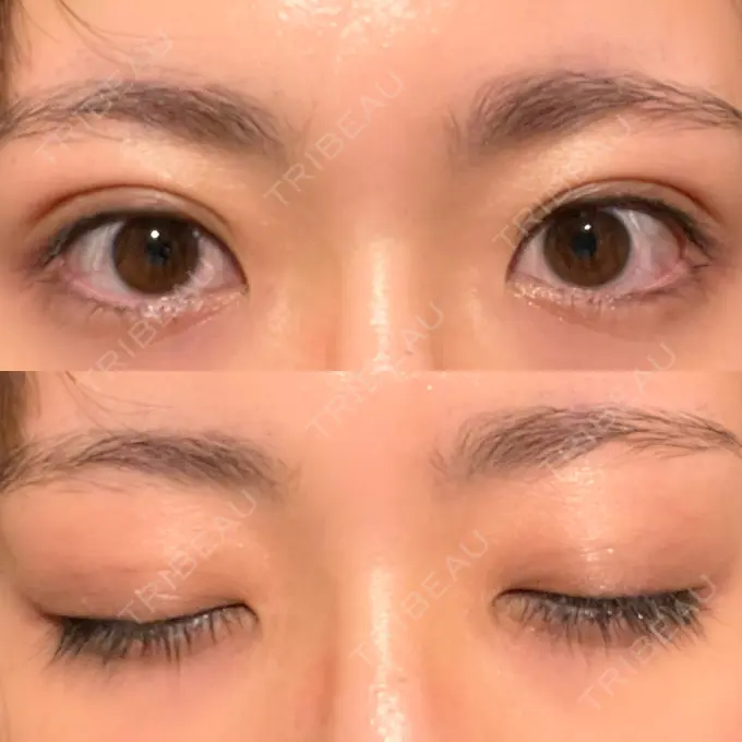 二重埋没 湘南メディカル記念病院（両国） DAY 22 メイン用