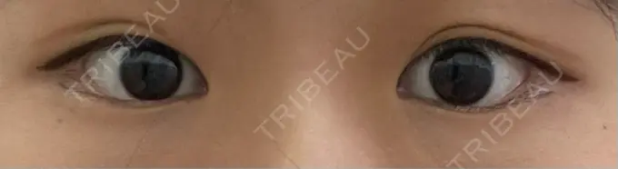 脂肪溶解注射（まぶた） Mare beauty clinic DAY 6 メイン用