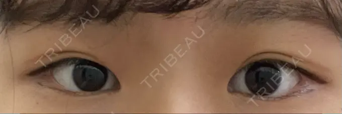 脂肪溶解注射（まぶた） Mare beauty clinic DAY 7 メイン用