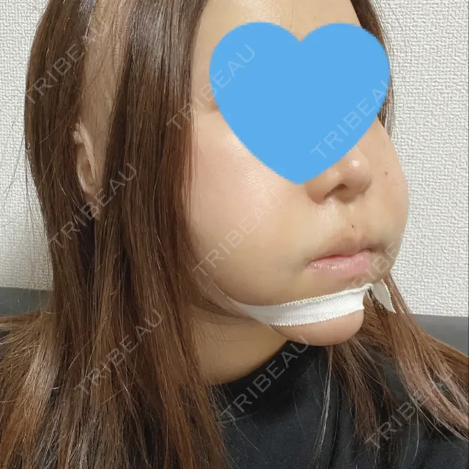 糸リフト / あごプロテーゼ / 脂肪吸引（顔） 湘南美容クリニック 上野院 DAY 0 メイン用