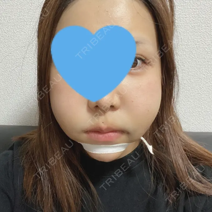 糸リフト / あごプロテーゼ / 脂肪吸引（顔） 湘南美容クリニック 上野院 DAY 0 メイン用