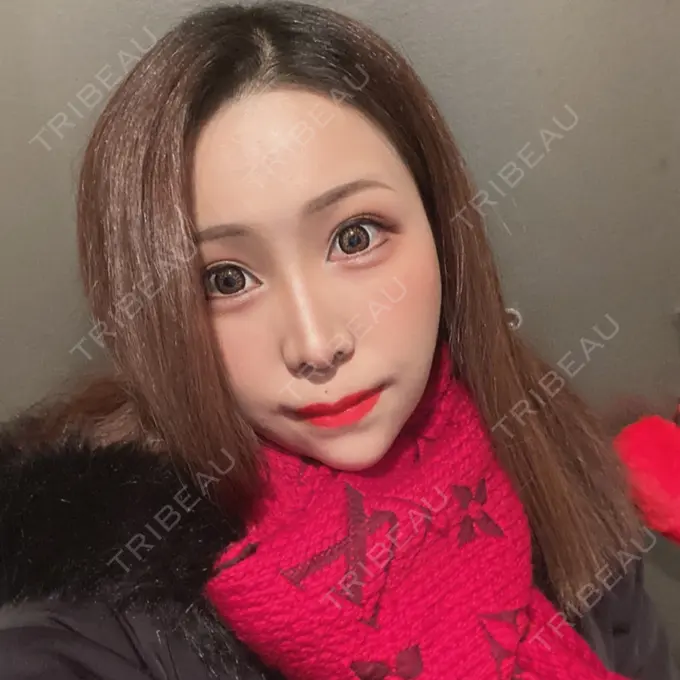 糸リフト / あごプロテーゼ / 脂肪吸引（顔） 湘南美容クリニック 上野院 DAY 21 メイン用