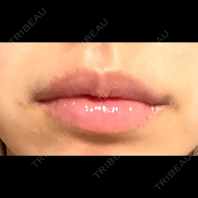 ヒアルロン酸注入（唇） / ボトックス（口角） フィラークリニック 名古屋栄院 DAY 1 メイン用