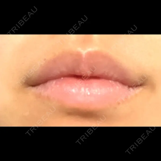 ヒアルロン酸注入（唇） / ボトックス（口角） フィラークリニック 名古屋栄院 DAY 3 メイン用