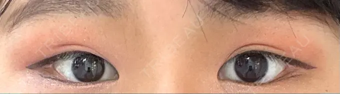 脂肪溶解注射（まぶた） Mare beauty clinic AFTER メイン用