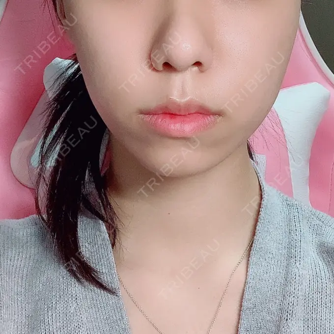 肌ヒアルロン酸注入（たるみ・シワ改善） / ボトックス（エラ・小顔） / その他（鼻） YBC横浜美容外科 大宮院 AFTER メイン用